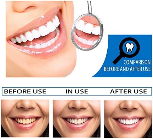 תמצית הלבנת שיניים מסובלות, הסרת כתמים להלבנת שיניים, הסרת כתמים אינטנסיבית שיניים הלבנת שיניים,