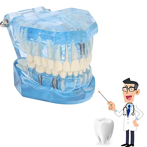 דגם שיני טיפוס, דגם שיניים נוח עם מודל שיניים ניתנת לניתוק לבית הספר למעבדות